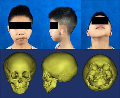 Whole-Exome Sequencing Reveals Rare Germline Mutations in Patients With Hemifacial Microsomia